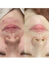 ラルーナ(La Luna)/ハーブピーリング