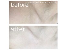 ラクシー 北千住(luxssy)/デコルテシェービング