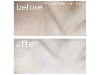 ラクシー 北千住(luxssy)/デコルテシェービング