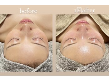 クレヴィー(Creviy)/陶肌トリートメント《Special》