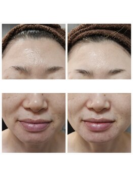 エターナル(Eternal)/ララピール 3回 終了