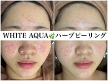 ホワイトアクア 京橋店(WHITE AQUA)/ハーブピーリング/ニキビケア