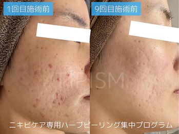 アクネラボ 梅田店(ACNE LABO)/ブライダル前に綺麗に