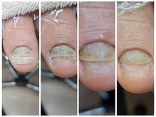 爪切り屋 足楽/お悩み「爪が伸びない・色が変」