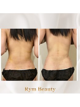リム ビューティー(RYM BEAUTY)/インディバ ボディ術後