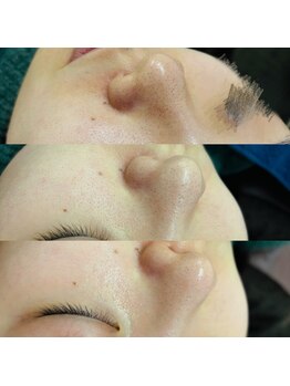 トゥインクル(Twinkle)/黒ずみ毛穴の改善に☆