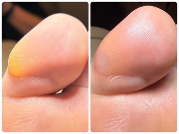 カルム 京都(Calme.)/硬いタコもすっきり綺麗に