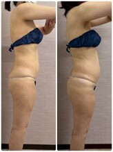 ソフィア わさだ店/40代セルゼロ全身コース10回