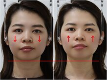 さつま骨格矯正 HRD広尾 西麻布院 /歪み小顔矯正 BeforeAfter