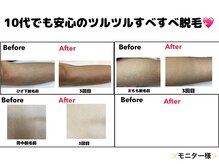 エステティック レイビス 秋田店(RAYVIS)/10代からのツルツル脱毛♪