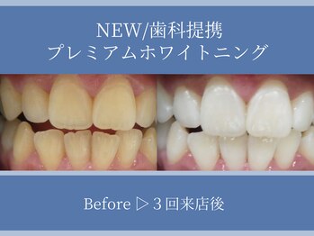 ホワイトニングカフェ 平塚店(WhiteningCafe)/◎歯のホワイトニング施術写真◎