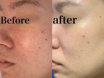 ヒール(heal)/症例