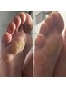 韓国足裏角質ケア（魚の目・/タコ/だれにも言えない足裏の悩みも◎)¥11000