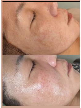 アレーズファイブフォー(A’LAISE54)/しみケア