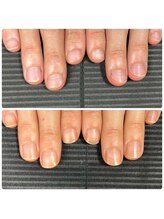 ウェルズユキ(well's yuki)/爪コンプレックス/深爪/横幅の爪