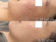 リスト(Rist TOTAL BEAUTY)/半年間の肌質改善結果