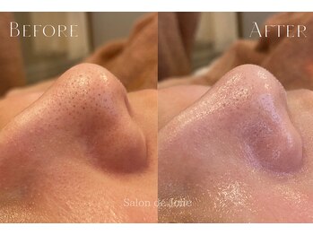 サロンドジョリー(Salon de Jolie)/【ハイドロ毛穴洗浄】