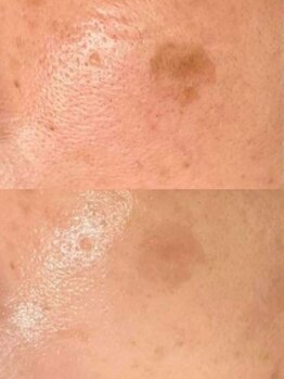 ラエッセ 目黒 白金台店(LAESSE)/毛穴・美白専門店 LAESSE 白金台