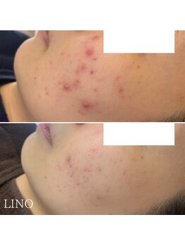 リノ(Lino)/ニキビケア