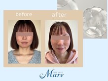 self salon Male【毛穴洗浄・ニキビ・肌質改善】セルフサロン マーレ