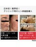 【乾燥荒れ/黒ずみ/シワ改善】エクソソーム配合ヒト幹細胞《16倍コース》40分