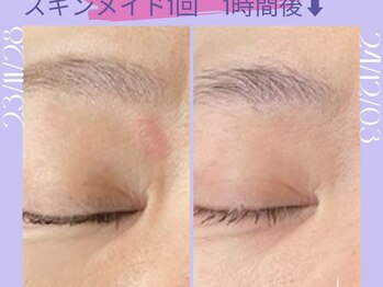 リラクゼーションサロン ラキ(laki)/スキンメイド/トロイアルケ