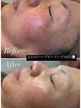 エル(Elle)/iLLONショートカットピーリング