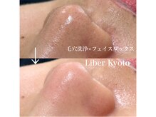 リベルキョウト 京都駅前店(Liber Kyoto)/タマゴ肌コース