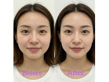 小顔輪郭矯正ビフォアフター♪小顔矯正/姿勢矯正/肩こり/名古屋
