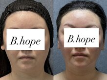 ビーホープ(B.hope)/40代モニター様の変化