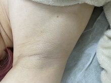 ナノハナ/鹿沼市の全身脱毛美容室ナノハナ