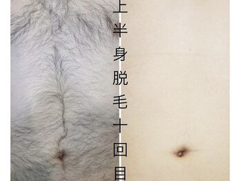 CDF 赤坂/上半身脱毛10回初回￥5500