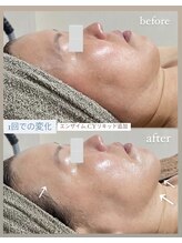 クレヴィー(Creviy)/ハーブ1回のbefore&after