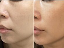 ミルジュ(MiLuJu)/美容溶解エンマ