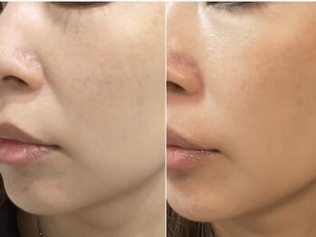 ミルジュ(MiLuJu)/美容溶解エンマ