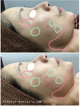 プリマプリート 各務原店/プラズマフォト&スノーピール