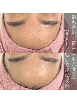 アウラプラス(Aura+)/毛穴開き症例/