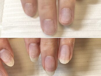 グラシュータン(gracieux temps)/【深爪矯正13000円】