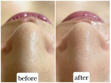 カレン アイビューティー(Karen Eyebeauty)/ララピールで小鼻もキレイに☆