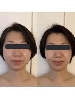 ハイコガオ 中崎町店(HIKOGAO)/小顔矯正