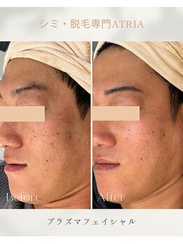 アトリア(ATRIA)/シミ改善フェイシャル