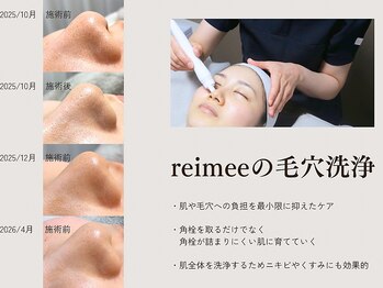 レイミー(reimee)/【毛穴洗浄】施術の様子・経過