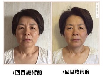 癒しの隠れ家サロン シュシュ(CHOU*CHOU)/フェイスリンパ90分施術前施術後