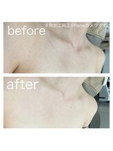 ラクシー 北千住(luxssy)/デコルテシェービング