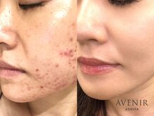 アベニール 芦屋/美肌に導く徹底改善