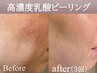 【毛穴の黒ずみ/くすみ/肌の老化】高濃度乳酸ピーリング＋肌別パック（90分）