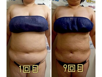 スマイルボディ つぼの森 加治木店(Smile body)/セレクト痩身☆ビフォーアフター