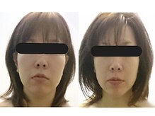 リラクゼーションサロン モアヴィ(More-Vi)の雰囲気（1度でしっかりフェイスラインがシャープに）