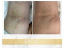 アンド エヌ(&n)/◆わき脱毛◆