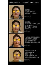 スイートボイス(sweet voice)/小顔矯正ビフォーアフター